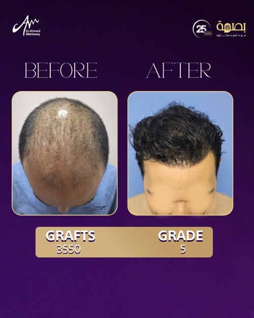 افضل دكتور زراعة شعر في مصر